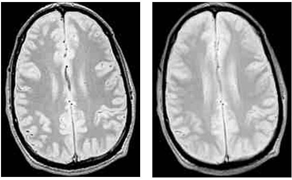 Рисунок 24. Изображения для толщины слайса в 3 мм (слева) и 10 мм (справа) [7]