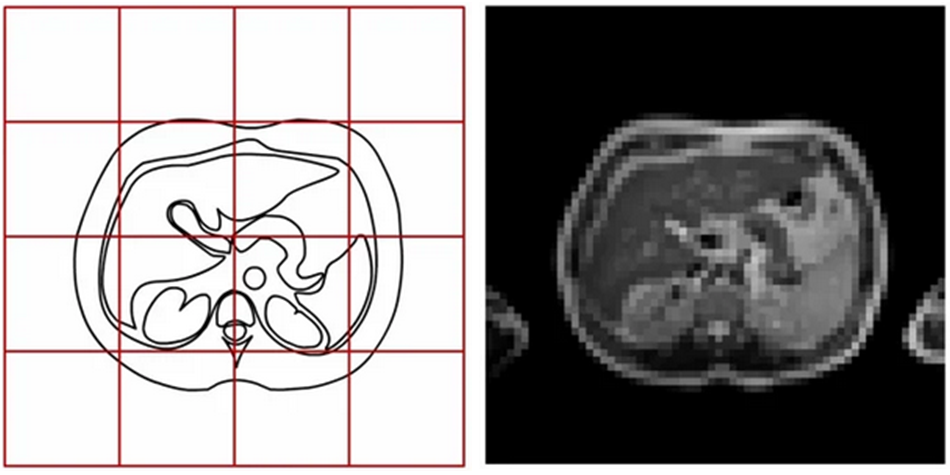 Рисунок 26. Большой FOV и маленькое К-пространство приводят к низкому разрешению изображений [4]