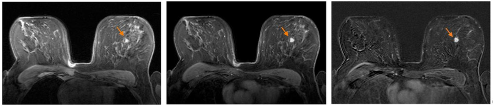 Рисунок 36. Аксиальный слайс Т1 до введения КВ (слева), после введения КВ (в центре) и их разность (справа). Стрелкой отмечена зона интереса с опухолью [4]