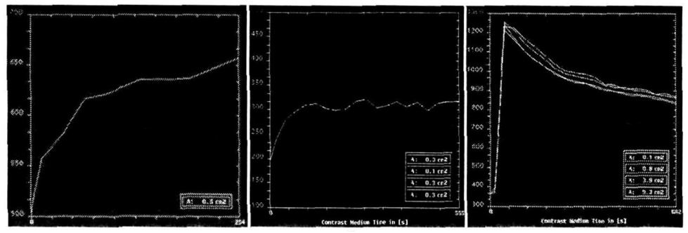 Рисунок 37. Разные типы кривых накопления и выведения контрастного вещества [источник]