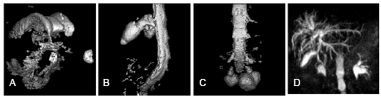 Рисунок 30. 3D-образы от режима MYUR: A — желудочки мозга при расширении прозрачной перегородки, B — невринома корешка спинного мозга, C — арахноидальные кисты позвоночного канала, D — картина внутрипеченочных желчных протоков [5]