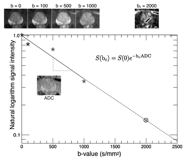 Рисунок 32. Линейная экстраполяция DWI с b-фактором 2000 из набора меньших значений [источник]