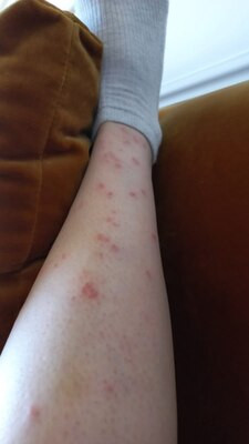 Как знатно накосячить косметологией (привет, ботулотоксин и наполнители) - 2 image