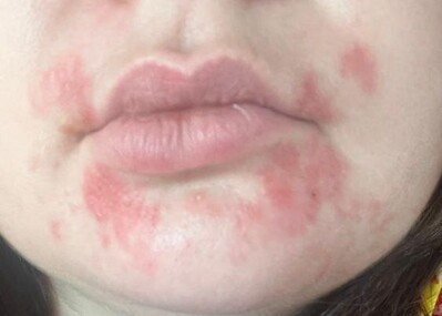 Как знатно накосячить косметологией (привет, ботулотоксин и наполнители) - 4 image