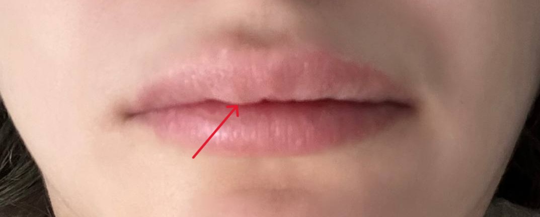 Как знатно накосячить косметологией (привет, ботулотоксин и наполнители) - 5 image