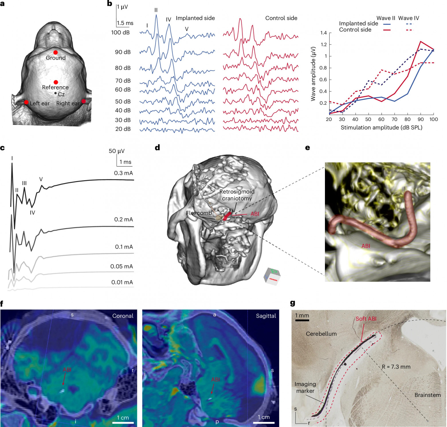 Восстановление слуха: мягкий слуховой стволомозговой имплант - 3