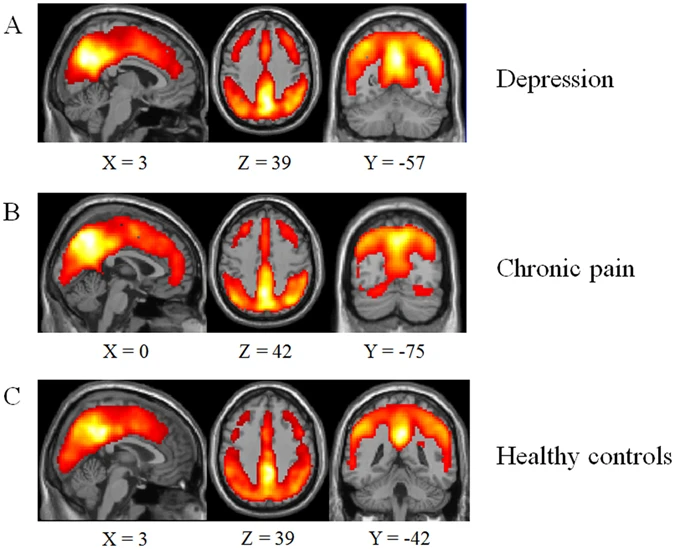 Среди прочего fMRT может помочь найти органические причины предрасположенности к депрессии