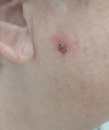 Плоскоклеточный рак