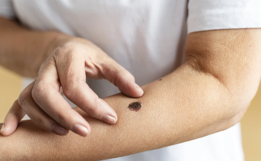 Зачем проверять родинки: взгляд врача-онкодерматолога - 1 Зачем проверять родинки: взгляд врача-онкодерматолога - 1