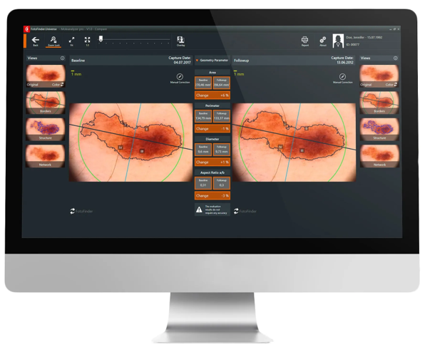 Как ИИ помогает выявлять рак кожи на ранней стадии - 3