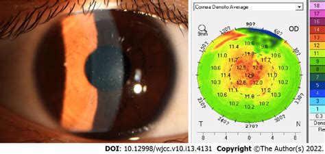 Slit-lamp photograph examination of grade 0 diffuse lamellar keratitis ...
