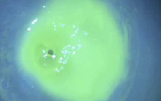 Десцеметоцеле (окраска флюоресцеином)