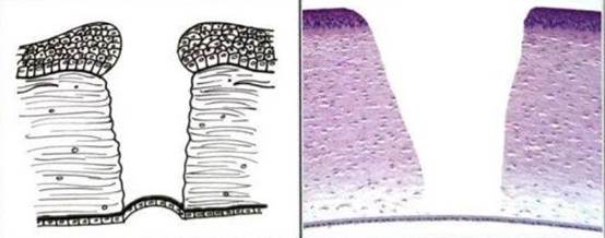 Десцеметоцеле (схема)