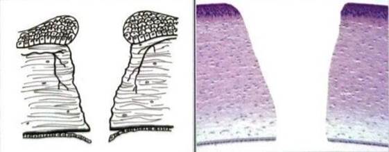 Перфорация роговицы (схема)