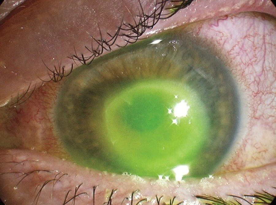 Фото: акантамебный кератит, окраска флюоресцеином (Acanthamoeba).