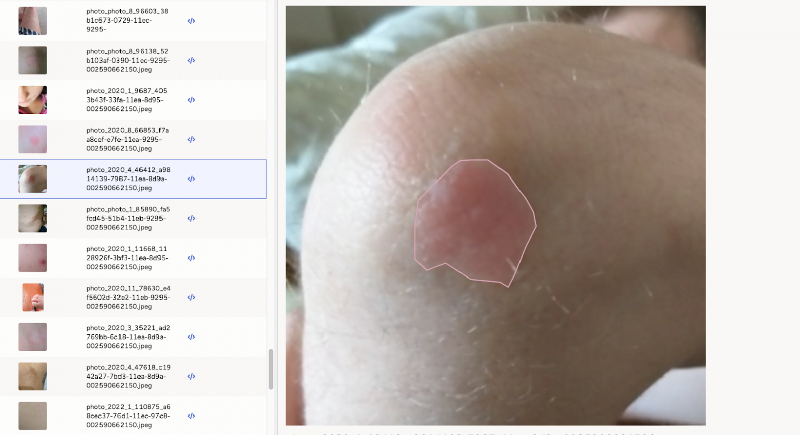 Разметка проблемного участка кожи на колене пациента 