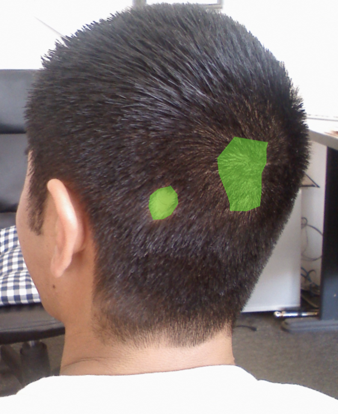 Пример разметки для дальнейшего анализа кожи и волос головы. После разметки приложение выполняет более глубокий анализ, который может включать сравнение с датасетом известных кожных заболеваний   