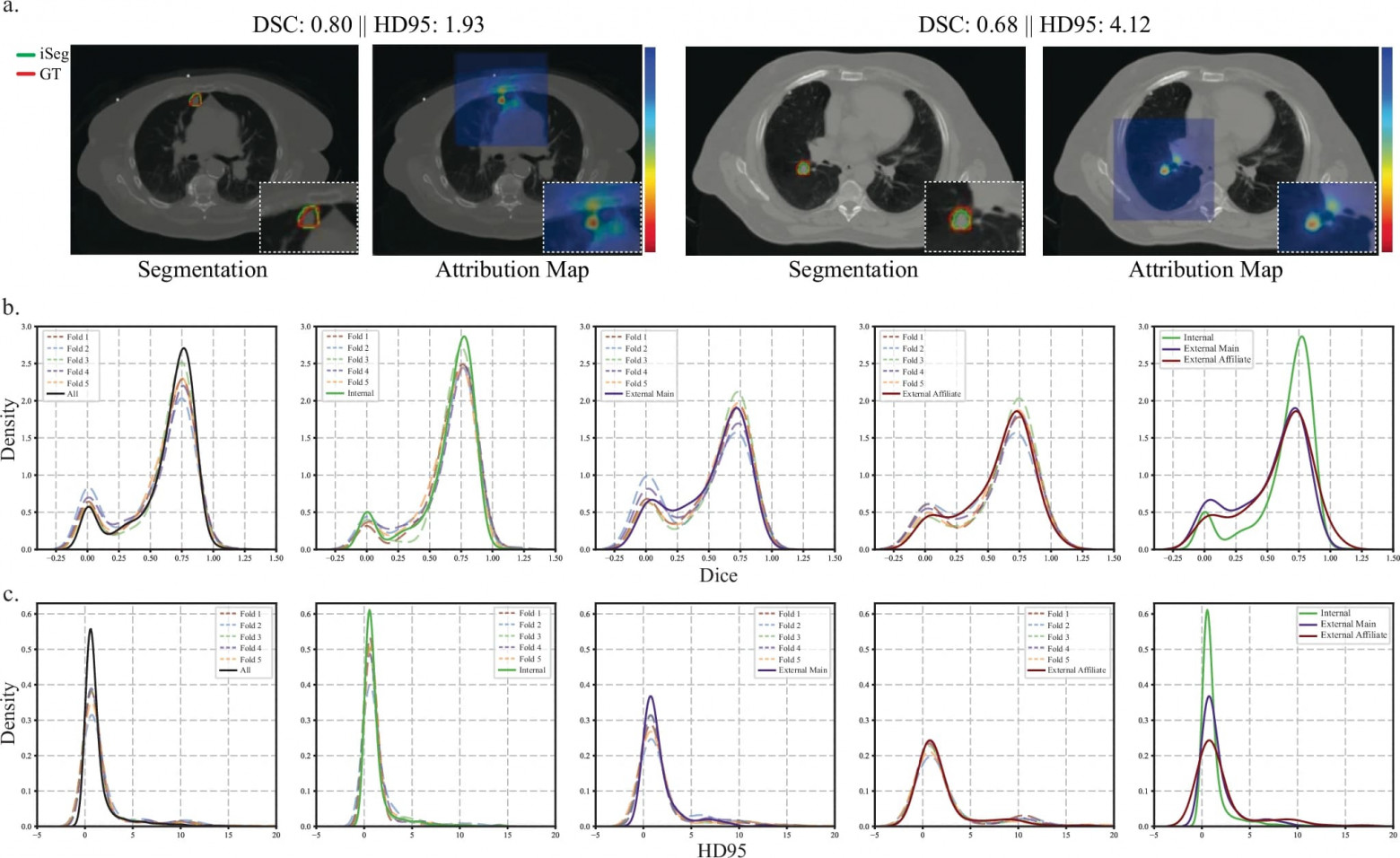 ИИ в радиологии: определение контура опухоли легких во время дыхания - 3 ИИ в радиологии: определение контура опухоли легких во время дыхания - 3