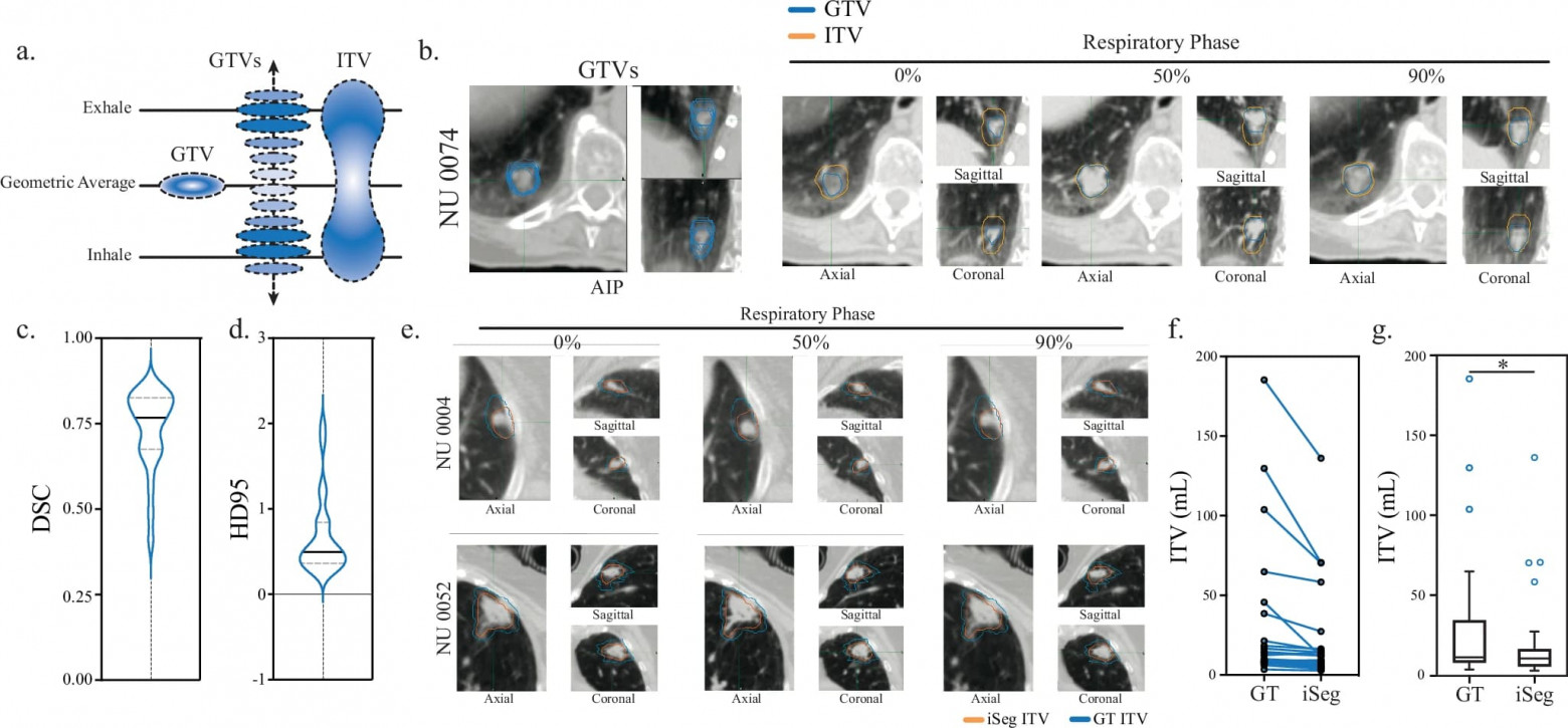ИИ в радиологии: определение контура опухоли легких во время дыхания - 5 ИИ в радиологии: определение контура опухоли легких во время дыхания - 5