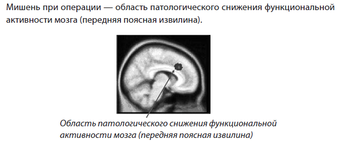 Рис. 43 Лечение навязчивых состояний с помощью операций на мозге