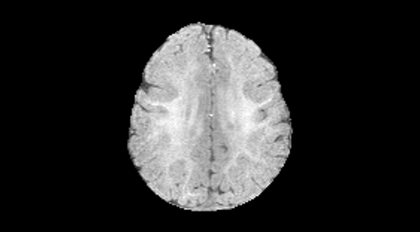 Повышаем точность диагностики ДЦП у новорожденных с помощью нейросетей - 13