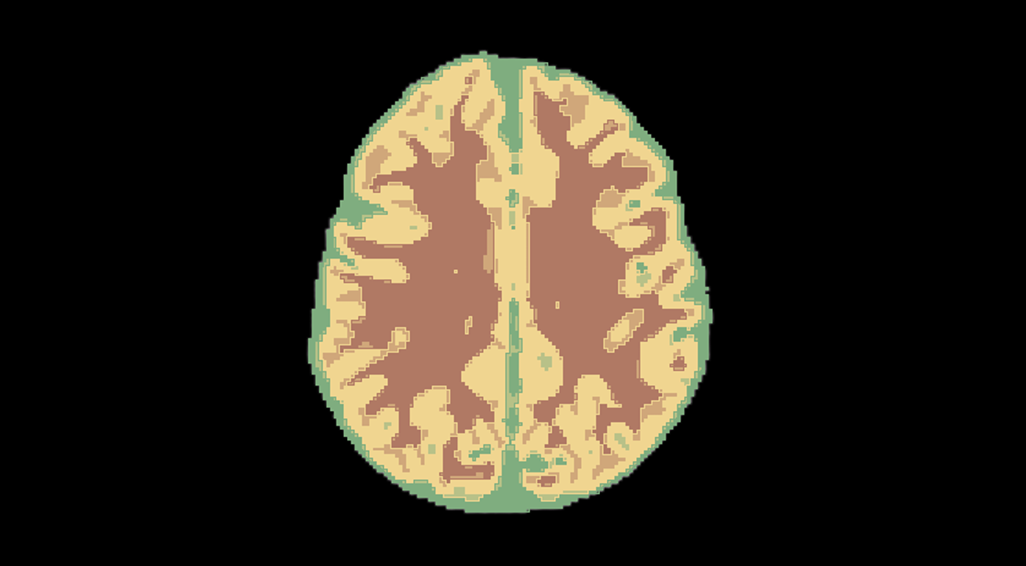 Повышаем точность диагностики ДЦП у новорожденных с помощью нейросетей - 14