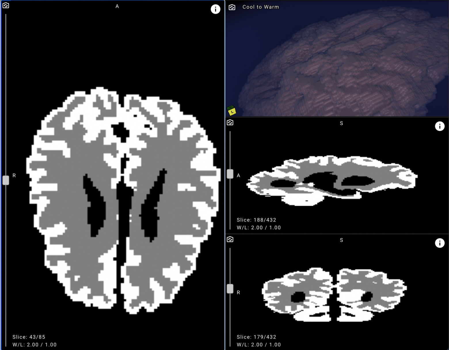 Повышаем точность диагностики ДЦП у новорожденных с помощью нейросетей - 17