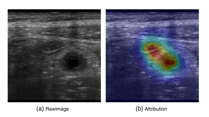 Пример использования атрибуции в классификации медицинских изображений. Согласно карте атрибуции, классификатор концентрируется на области вокруг аппендикса. Источник изображения