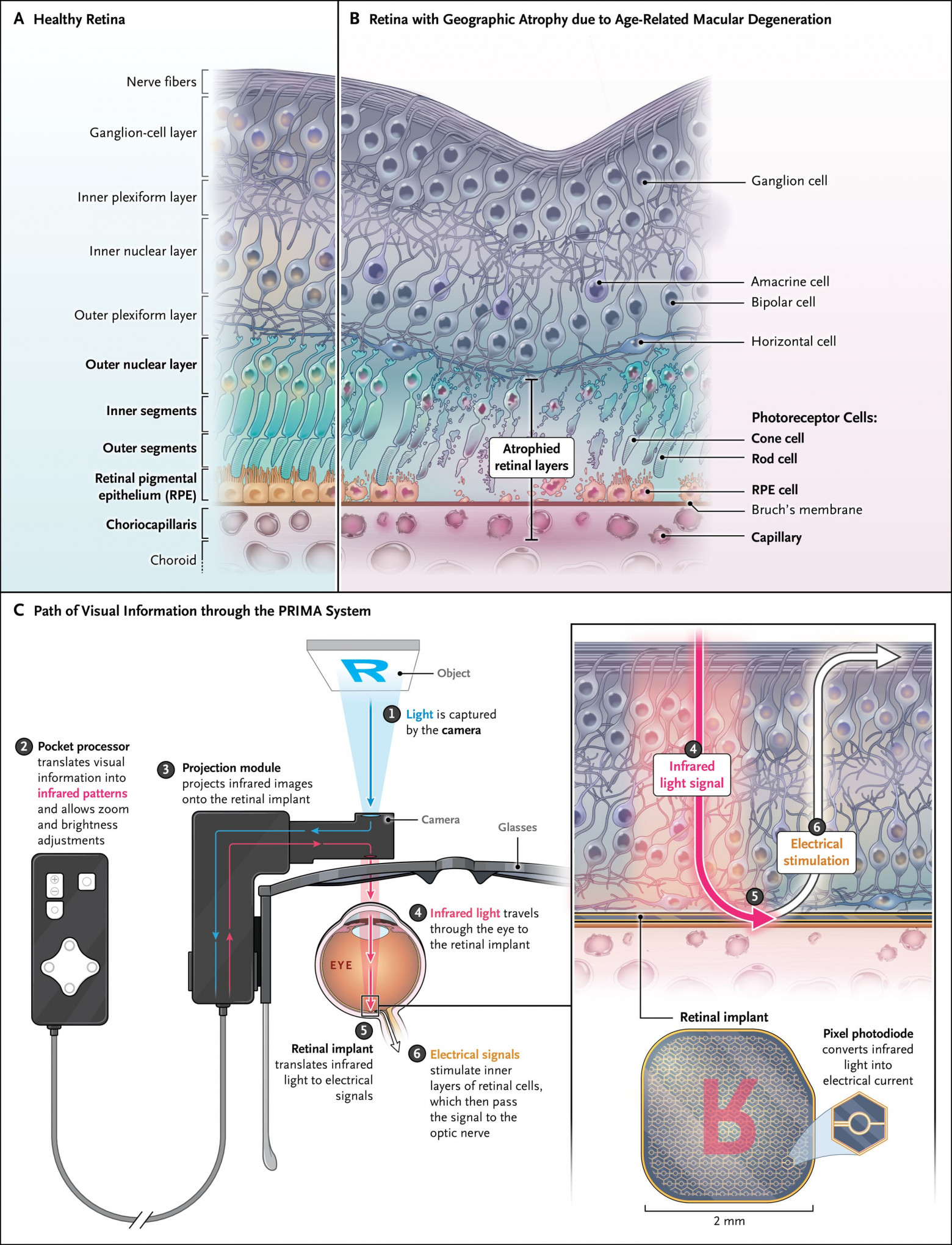 Видеть вновь: ИИ, глазной имплантат и очки дополненной реальности - 2