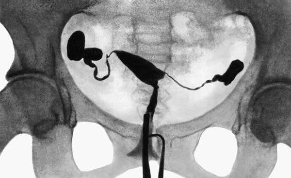 Гистеросальпингография