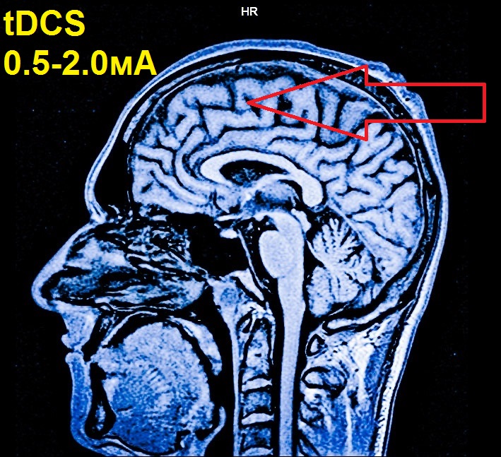 Транскраниальный стимулятор (tDCS) своими руками - 1 Транскраниальный стимулятор (tDCS) своими руками - 1