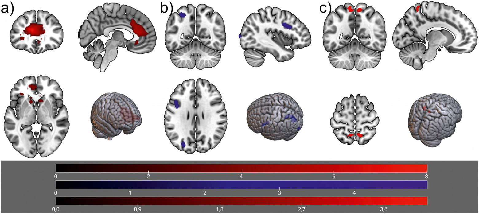 Реакция мозга на сигналы о смартфоне до и после 72-часового воздержания, разницы прогонов тестов cue-reactivity. (a) Красным показаны области, где после ограничения усилилась реакция на изображения смартфона по сравнению с нейтральными картинками. (b) Синим выделены области, где до ограничения мозг сильнее различал включённый и выключенный смартфон; после ограничения эта разница стала меньше. (c) Особые свойства участников с выраженным чрезмерным использованием смартфона: после 72 часов без смартфона сильнее, чем у остальных, выросла реакция на разницу между горящим и выключенным экраном смартфона; красным отмечены те области, где этот контраст оказался выше. Цветовые шкалы показывают t-значения контрастов. doi:10.1016/j.chb.2025.108610