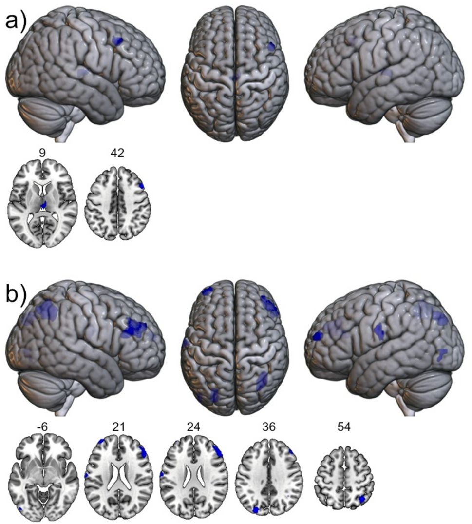 Участки мозга, где реакция на смартфонные стимулы у мужчин сильнее, чем у женщин. Цветом отмечены зоны с более высоким сигналом фМРТ у мужчин: (a) при сравнении изображений смартфона с нейтральными картинками; (b) при сравнении смартфона с включённым экраном и с выключенным. Сверху — проекции на поверхность мозга, снизу — срезы. doi:10.1186/s13293-026-00835-7