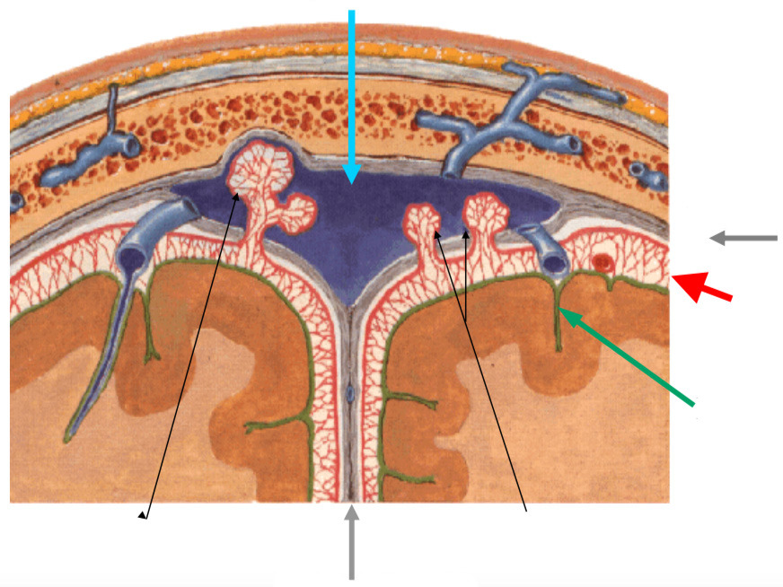Голубая стрелка — верхний сагиттальный синус, место посадки Stentrode