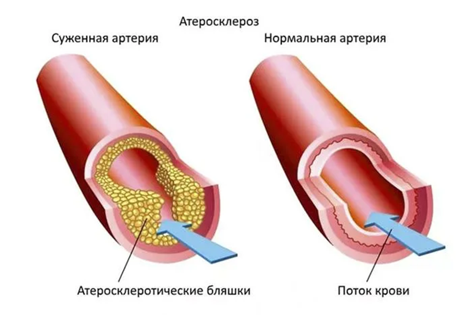 Можно ли заранее увидеть риск инфаркта? - 3 Можно ли заранее увидеть риск инфаркта? - 3