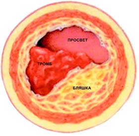 Кровяные сгустки, тромбы, развиваются в области атеросклеротических бляшек, образующихся на внутренних стенках сосуда. Тромбы могут полностью перекрывать даже крупные сосуды, вызывая серьезные нарушения мозгового кровообращения.