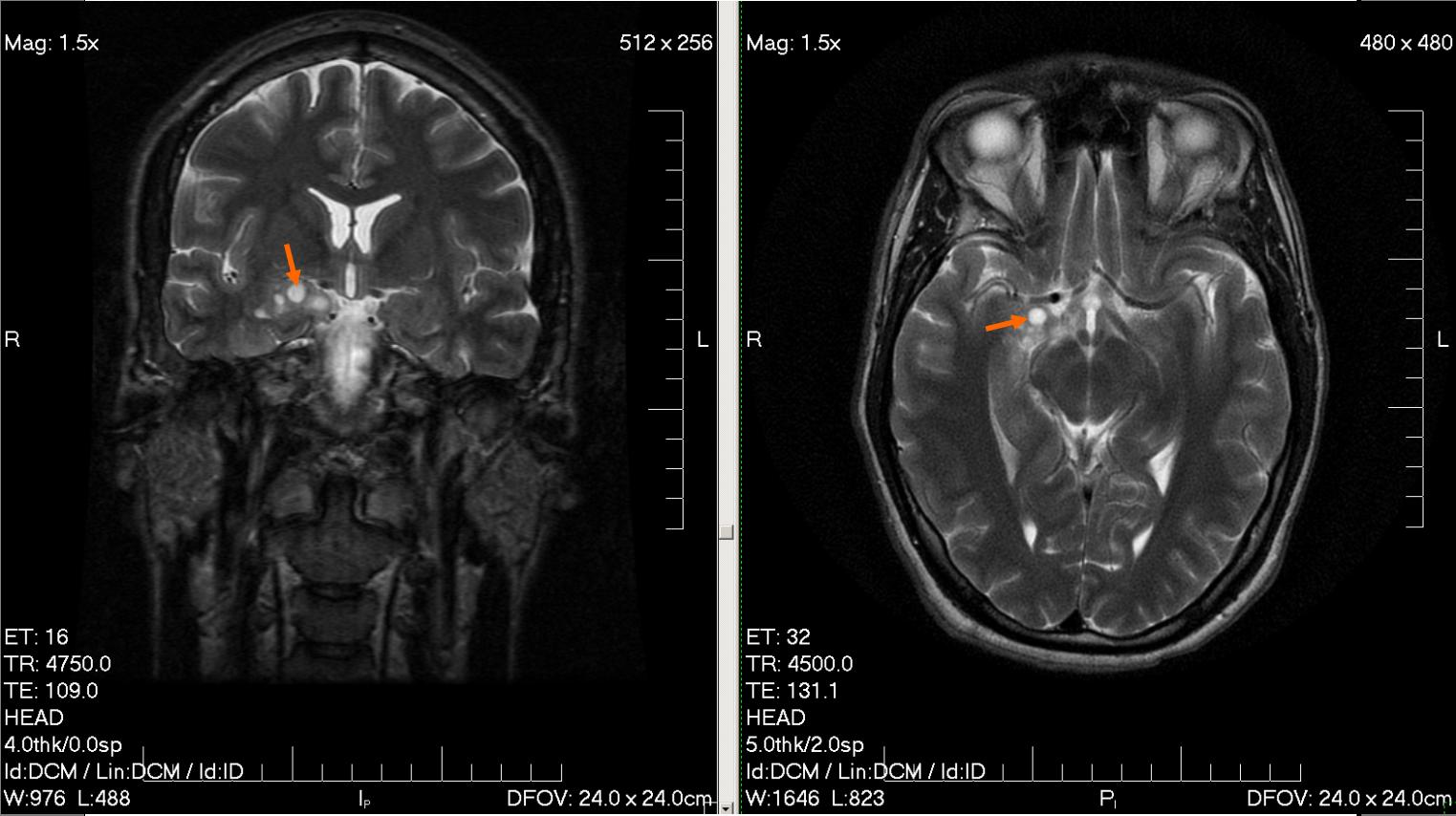 Опухоль головного мозга у 28-летнего мужчины выявлена с помощью МРТ