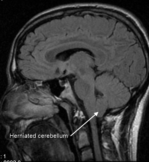 МРТ. Синдром Арнольда — Киари I. Стрелкой указано выпячивание миндалин мозжечка в просвет позвоночного канала