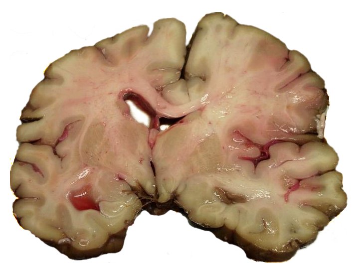 Срез мозга погибшего от инсульта