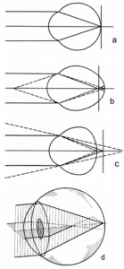 Ход лучей при различных видах клинической рефракции глаза